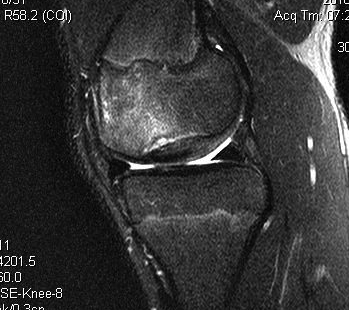 Femoral OCD Type 3 MRI